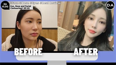 lv plastic surgery reviews|lv plastic surgery korea.